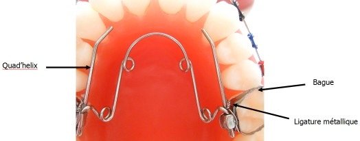 incidents et urgences orthodontiques Guilherand Granges