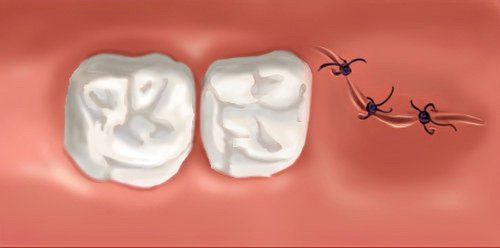 Cabinet orthodontiste Guilherand Granges dents de sagesse