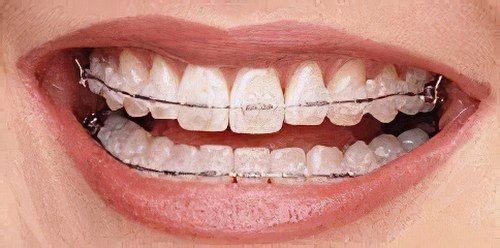 La réussite d’un traitement d'orthodontie
