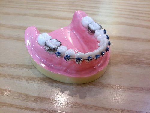 orthodontiste Guilherand Granges orthodontie adultes