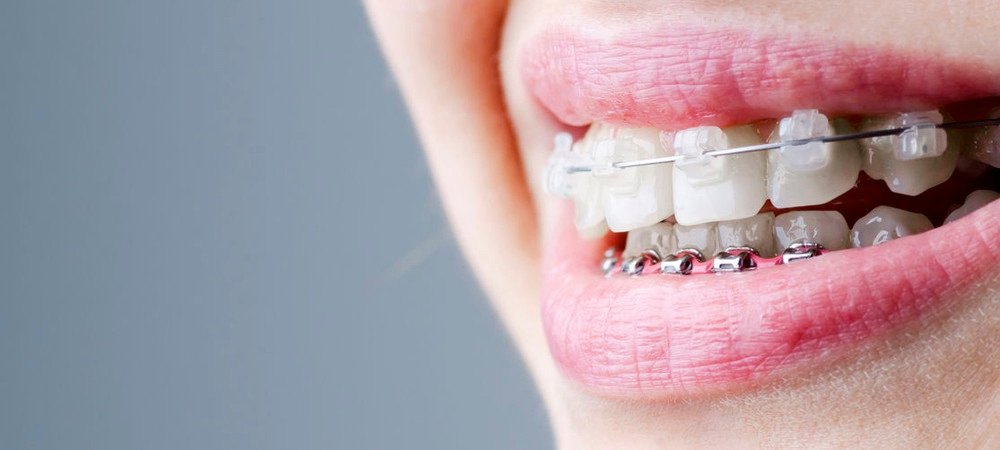 questions fréquentes sur l'orthodontie