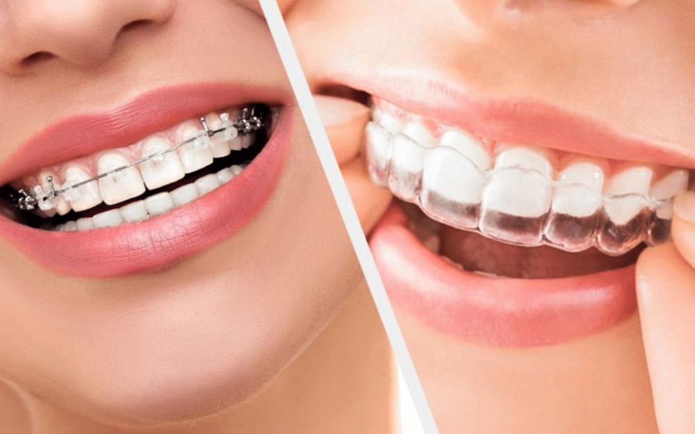 Qu’est ce que l’orthodontie